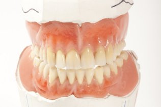 vereiterter Zahn